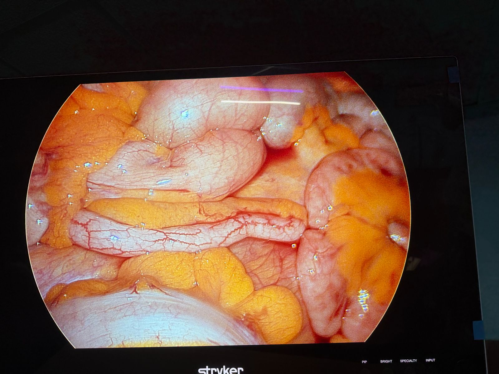 Dr. Mariam Anjum — Appendix — Surgical Atlas